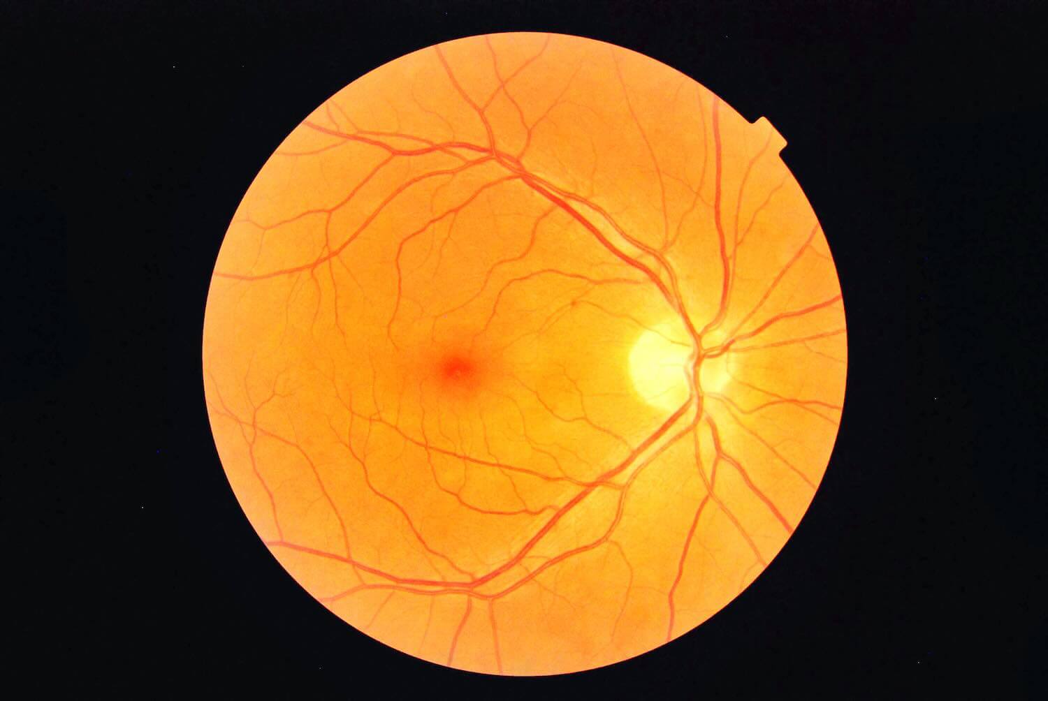 Distacco di Retina Distacco di Retina