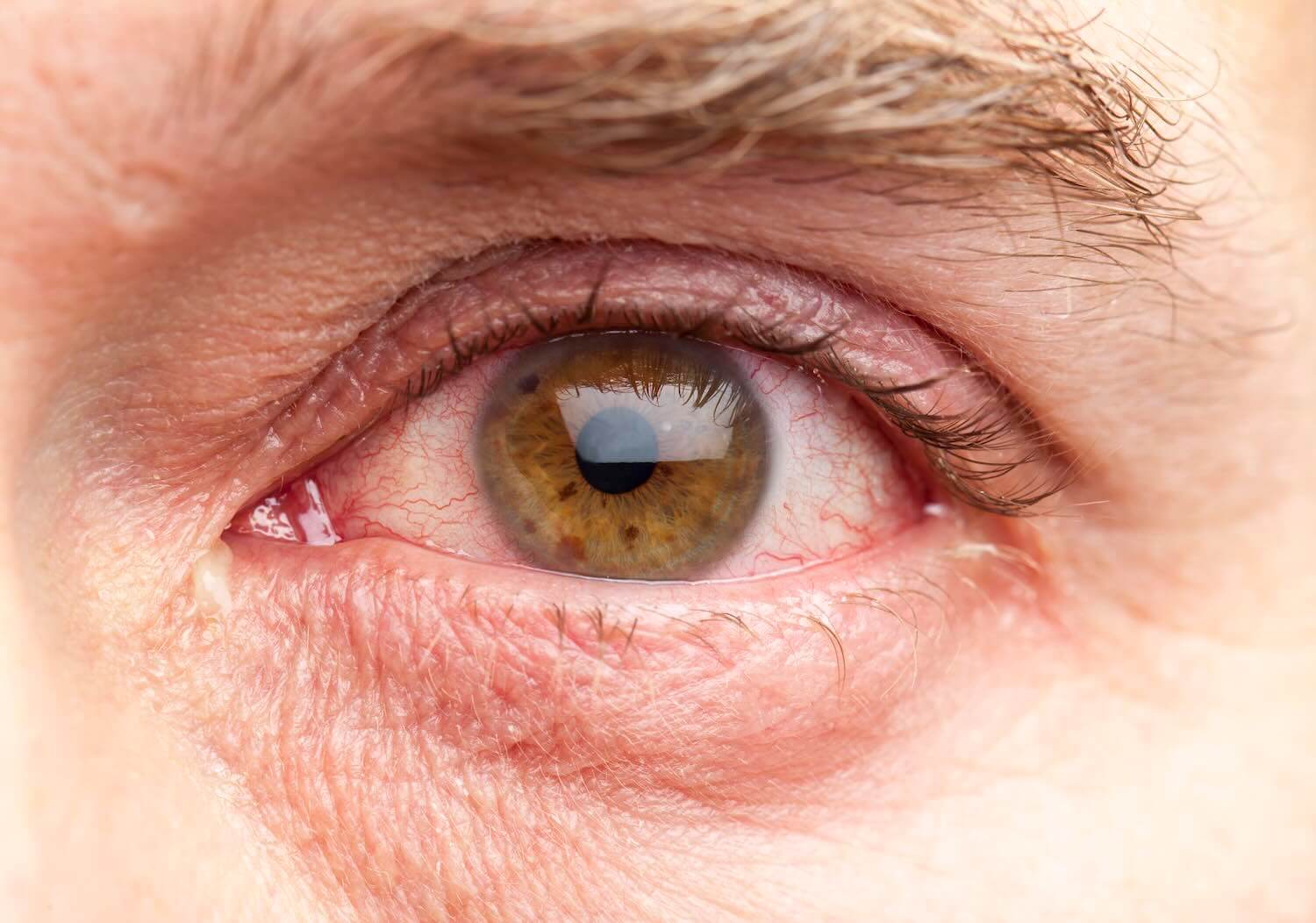 Retinopatia diabetica Retinopatia diabetica