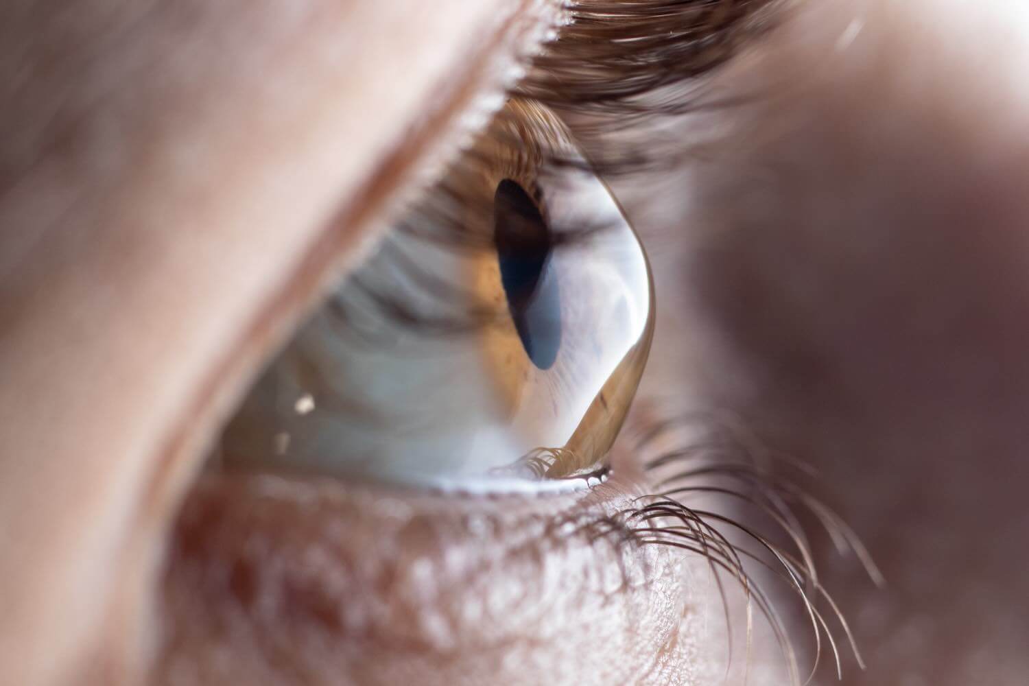 Cheratocono: cornea che si deforma a cono vista in topografia corneale Topografia corneale per la diagnosi precoce del cheratocono